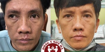 Tại sao mắt bị lác ngoài? Cách điều trị?