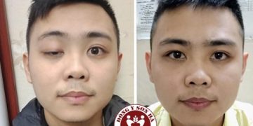 Tự nhiên sụp mí mắt phải làm sao?