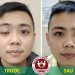 Tự nhiên sụp mí mắt phải làm sao?